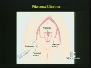 DICA 33 - OPERARE UN FIBROMA CON LA CHIRURGIA SENZA BISTURI