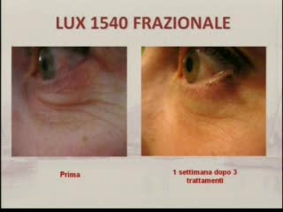 DICA 33 - RUGHE, COME ELIMINARLE CON IL LASER