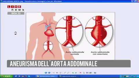 Che cos'è l'aneurisma dell'aorta?