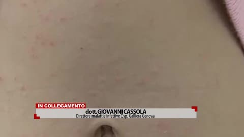 Allarme scabbia a Ventimiglia, il medico: 